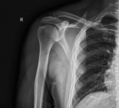X-ray right shoulder minimum 2 views X-ray right shoulder minimum 2 views
