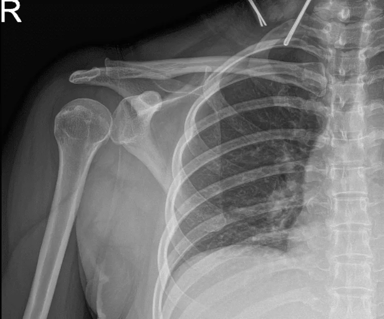 Radiografía del hombro derecho