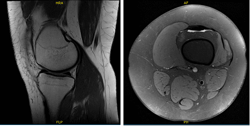 Radiografía de rodilla izquierda