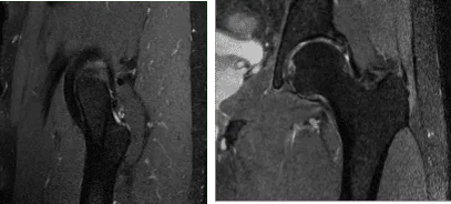 MRI Left Hip non-contrast