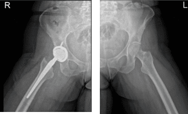 Hip Bilateral with pelvis 3 or 4 more view