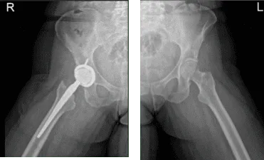 Hip Bilateral with pelvis 3 or 4 more view