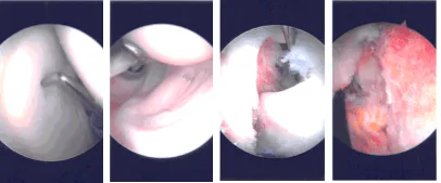 Imágenes de artroscopia intraoperatoria