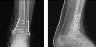 Radiografía del tobillo izquierdo completada 3 o más visitas 1 semana después de la operación