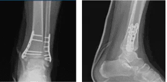 Left Ankle X-ray complete 3 or more views 1 week post operative