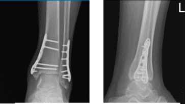 Radiografía del tobillo izquierdo completada 3 o más visitas 8 semanas después de la operación Radiografía del tobillo izquierdo completada 3 o más visitas 8 semanas después de la operación