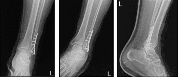 Left ankle X-ray complete 3