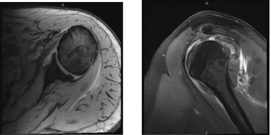 MRI-3T Hombro izquierdo sin contraste