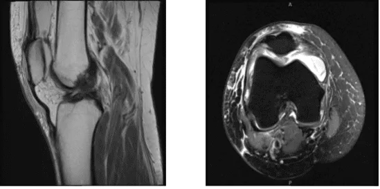 MRI-3T Rodilla derecha sin contraste