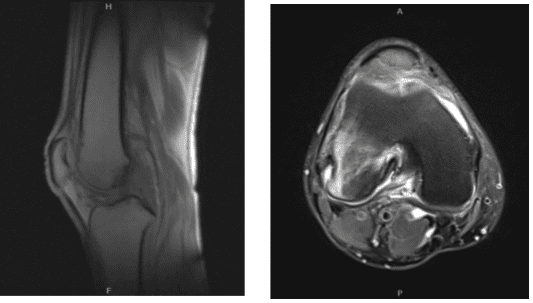 MRI-3T Rodilla derecha sin contraste
