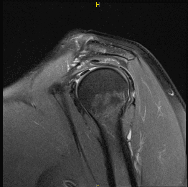 MRI-3T hombro izquierdo sin contraste