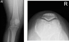 MRI-3T right knee non-contrast MRI-3T right knee non-contrast