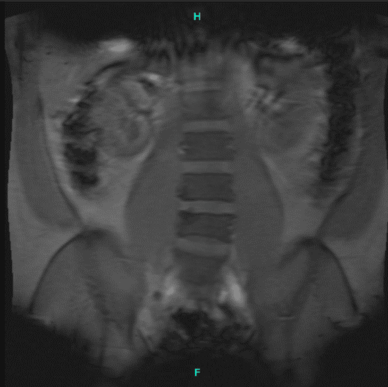 MRI Lumbar Spine non-contrast
