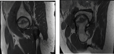 MRI Right hip non-contrast