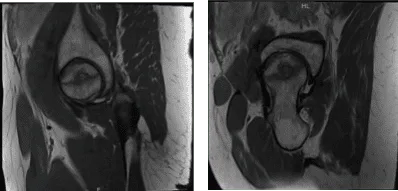 MRI Right hip non-contrast