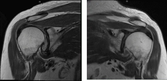 MRI of Left and Right Shoulder
