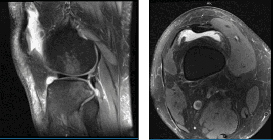 MRI of knee