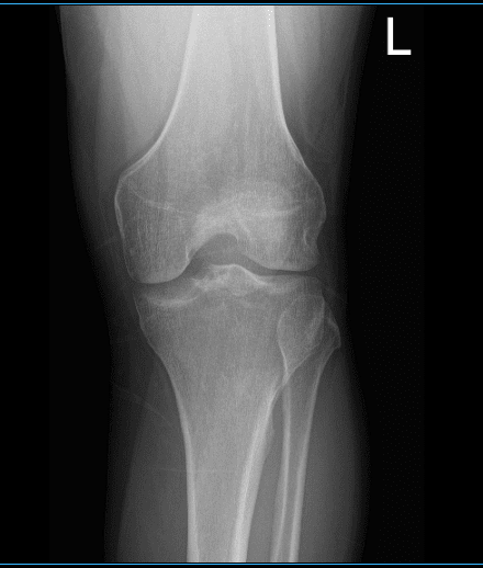 Resonancia magnética de la rodilla izquierda