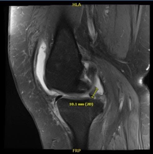 Resonancia magnética de la rodilla derecha