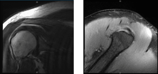 MRI of right shoulder