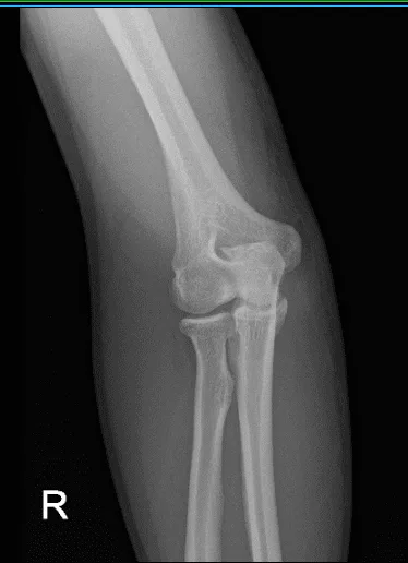 Postoperative X-ray of right elbow