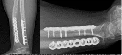 Right Forearm X-ray-32nd week post-operative