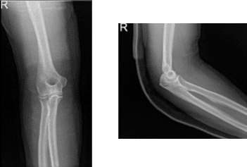 Radiografía del codo derecho