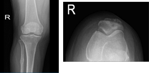 Radiografía de rodilla derecha AP y Lateral