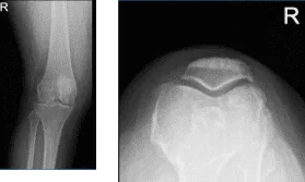Right knee X-ray