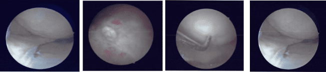 Intraoperative Arthroscopic Images