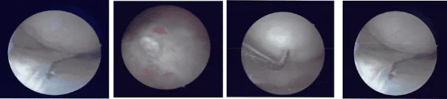 Intraoperative Arthroscopic Images
