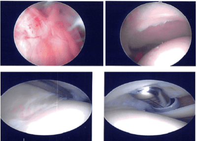 Imágenes de artroscopia intraoperatoria