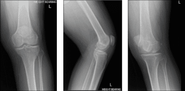 Resonancia magnética de rodilla izquierda Resonancia magnética de rodilla izquierda