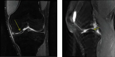 Resonancia magnética de la rodilla izquierda