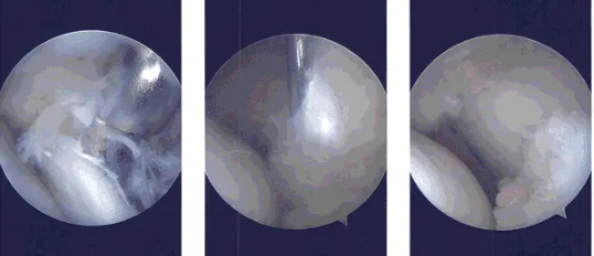 Intraoperative Arthroscopy Images