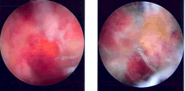 Intraoperative Images Intraoperative Images