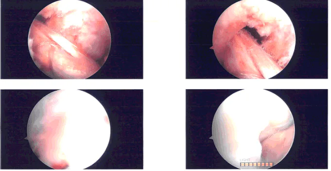 Imágenes de artroscopia intraoperatoria