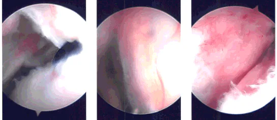 Imágenes de artroscopia intraoperatoria