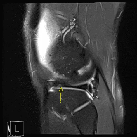 Resonancia magnética de la rodilla derecha
