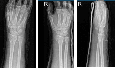 MRI of the wrist